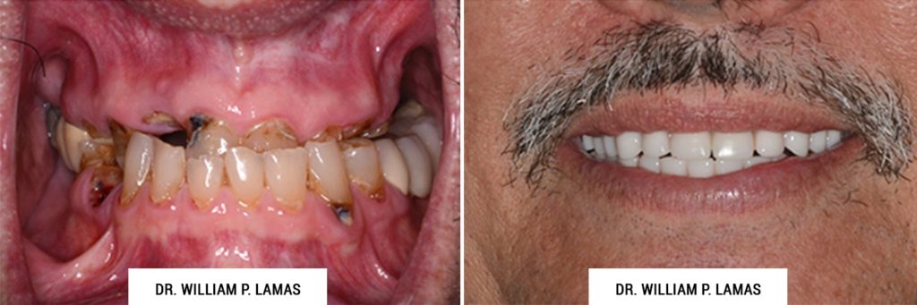TeethXPress Dental Implants Before & After Photo - William P. Lamas, DMD - Periodontics & Dental Implants. Address: 2645 SW 37th Ave Suite 304, Miami, FL 33133 Phone: (305) 440-4114